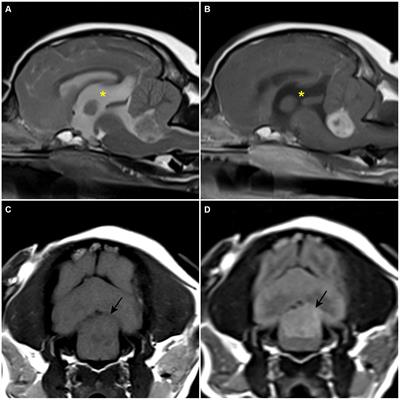 Case report: Gross total resection of a primary fourth ventricular meningioma using the telovelar approach in a dog